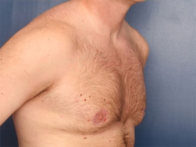 After Image: Gynecomastia - right-front-oblique
