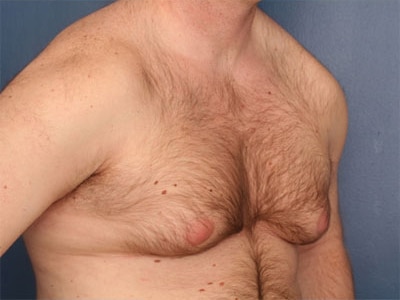 Before Image: Gynecomastia - right-front-oblique