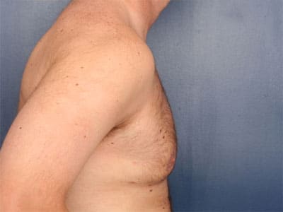 After Image: Gynecomastia - right-side