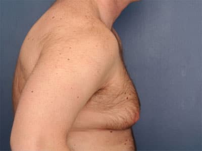 Before Image: Gynecomastia - right-side