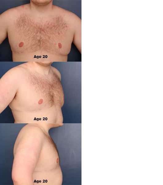 After Image: Gynecomastia - front