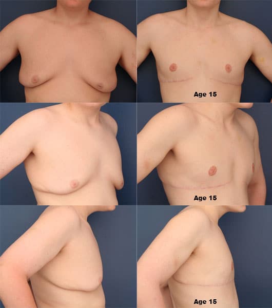 Before Image: Gynecomastia - front