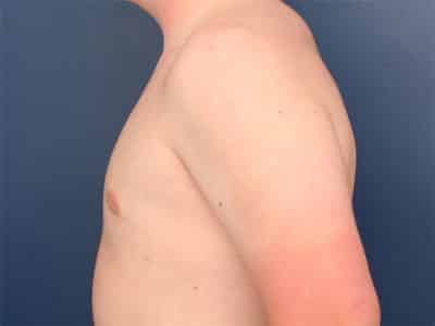 After Image: Gynecomastia - left-side