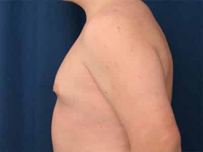 Before Image: Gynecomastia - left-side