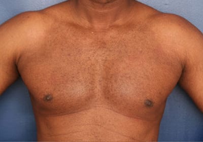 After Image: Gynecomastia - front