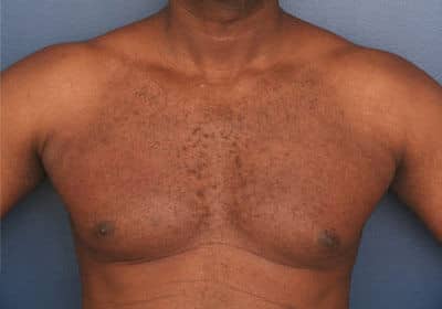 Before Image: Gynecomastia - front