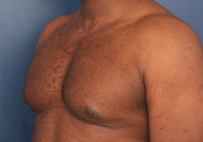 Before Image: Gynecomastia - left-front-oblique