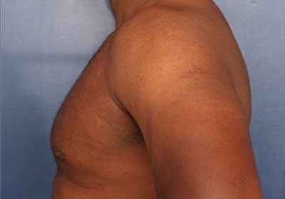 After Image: Gynecomastia - left-side