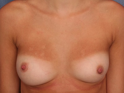 After Image: Inverted Nipple - front