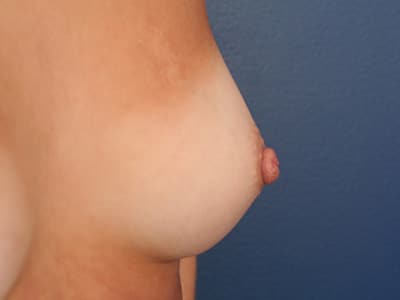 After Image: Inverted Nipple - right-front-oblique