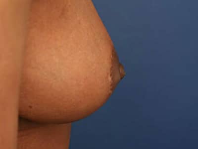 After Image: Inverted Nipple - right-side