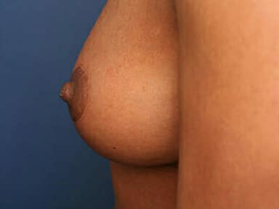 After Image: Inverted Nipple - left-side