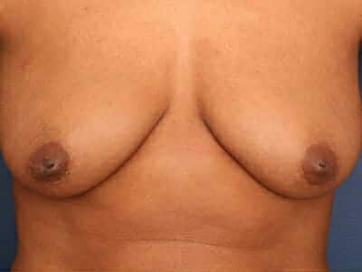 Before Image: Inverted Nipple - front