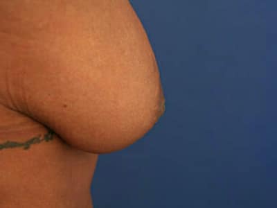 Before Image: Inverted Nipple - right-side