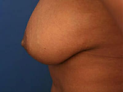 Before Image: Inverted Nipple - left-side