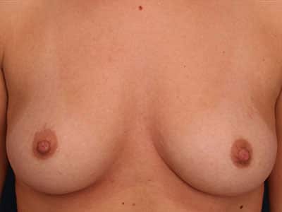 After Image: Inverted Nipple - front