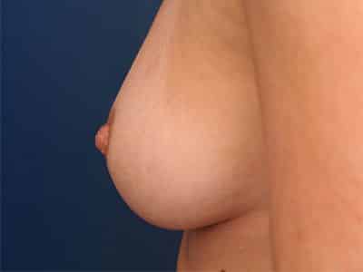 After Image: Inverted Nipple - left-side
