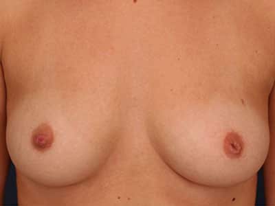 Before Image: Inverted Nipple - front