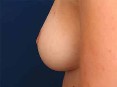 Before Image: Inverted Nipple - left-side