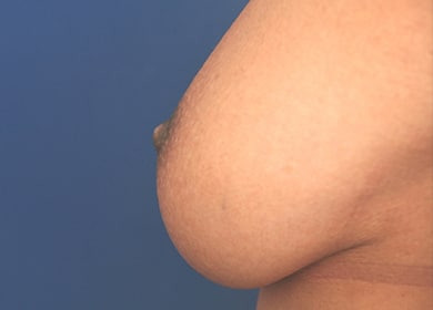 After Image: Inverted Nipple - left-side