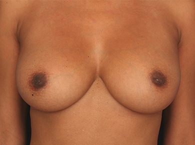 Before Image: Inverted Nipple - front