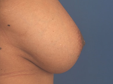 Before Image: Inverted Nipple - right-side