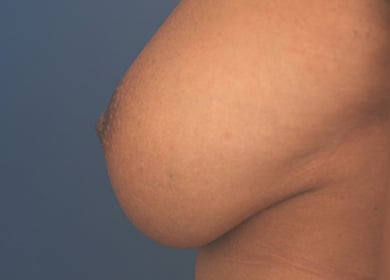 Before Image: Inverted Nipple - left-side