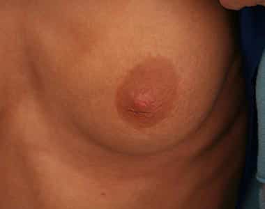 Before Image: Inverted Nipple - front