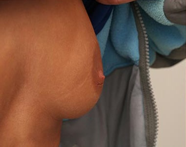Before Image: Inverted Nipple - right-front-oblique