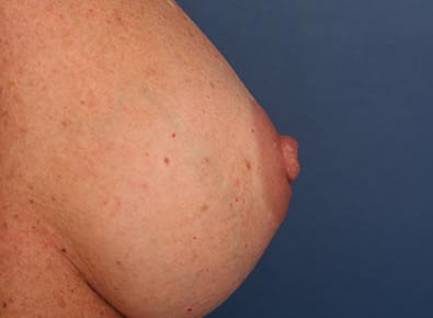 After Image: Inverted Nipple - right-side