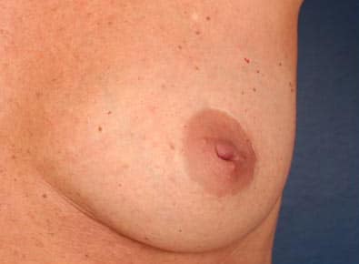 Before Image: Inverted Nipple - front
