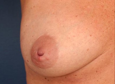 Before Image: Inverted Nipple - front