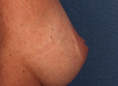 Before Image: Inverted Nipple - right-side