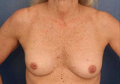 Before Image: Inverted Nipple -