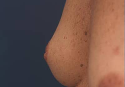 Before Image: Inverted Nipple -