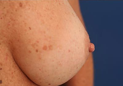 After Image: Inverted Nipple - right-front-oblique