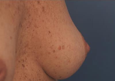 Before Image: Inverted Nipple - right-front-oblique