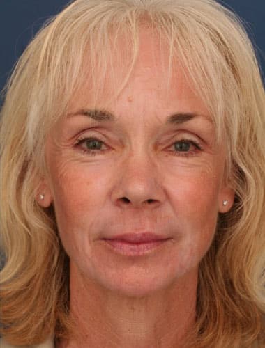After Image: Laser Resurfacing - front