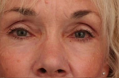 After Image: Laser Resurfacing - front