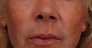 After Image: Laser Resurfacing - front