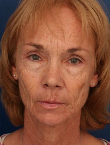 Before Image: Laser Resurfacing - front