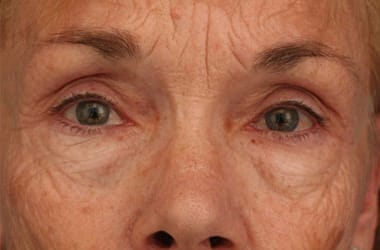 Before Image: Laser Resurfacing - front