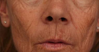 Before Image: Laser Resurfacing - front