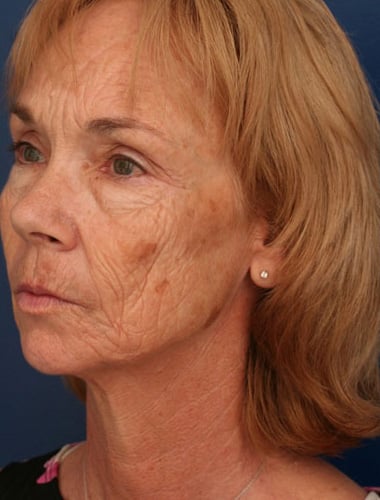 Before Image: Laser Resurfacing - left-front-oblique