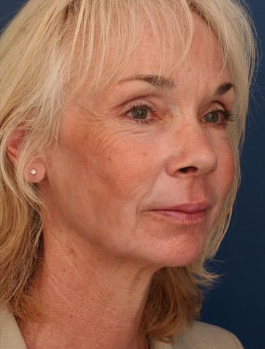 After Image: Laser Resurfacing - right-front-oblique