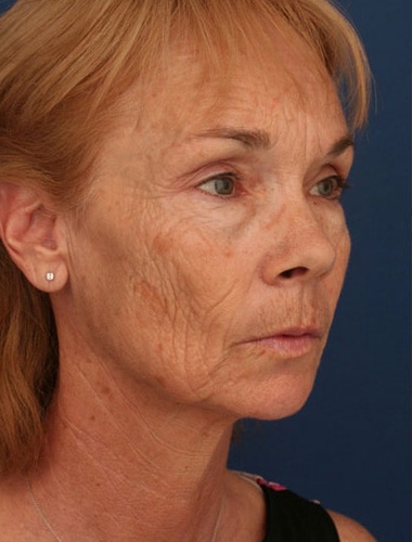 Before Image: Laser Resurfacing - right-front-oblique