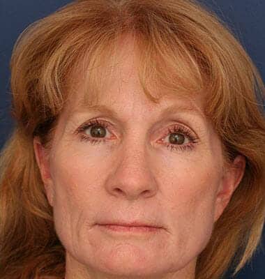 After Image: Laser Resurfacing - front