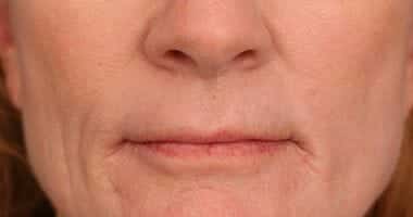 After Image: Laser Resurfacing - front