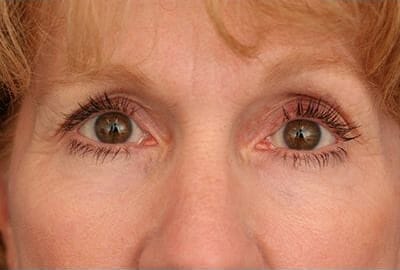 After Image: Laser Resurfacing - front