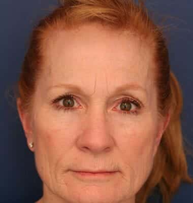Before Image: Laser Resurfacing - front